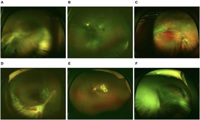 The Value of the Antibody Detection in the Diagnosis of Ocular Toxocariasis and the Aqueous Cytokine Profile Associated With the Condition